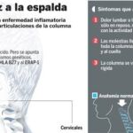 Columna rígida: los fármacos biológicos reducen un 60% las prótesis de cadera