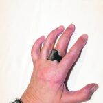 «Una máquina me cortó la mano»