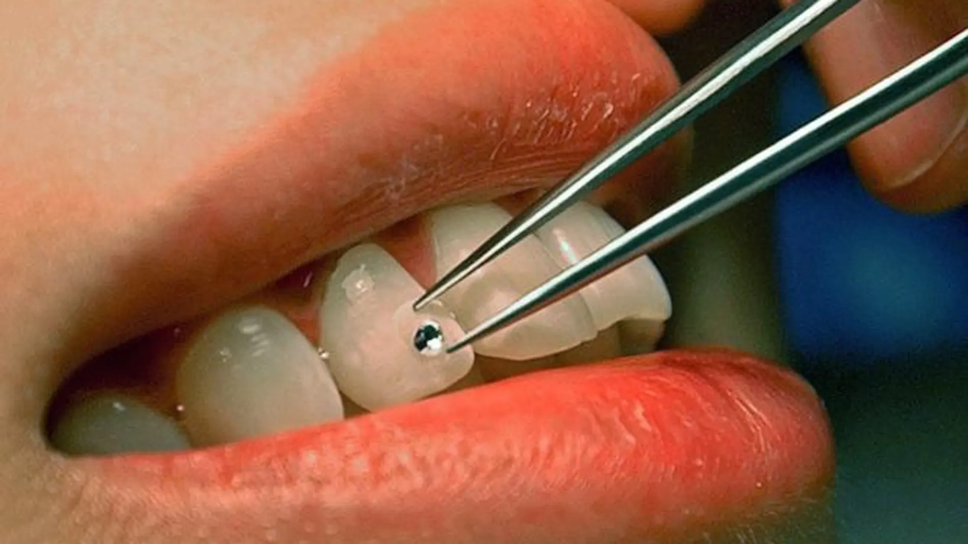 El hombre con más suerte del mundo gracias a su dentadura