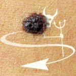 Lunares, de enemigos a aliados contra el tumor