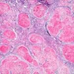 La curación de la hepatitis C podría ser una realidad dentro de dos años