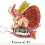 Nuevo sistema de tratamiento del cáncer de próstata