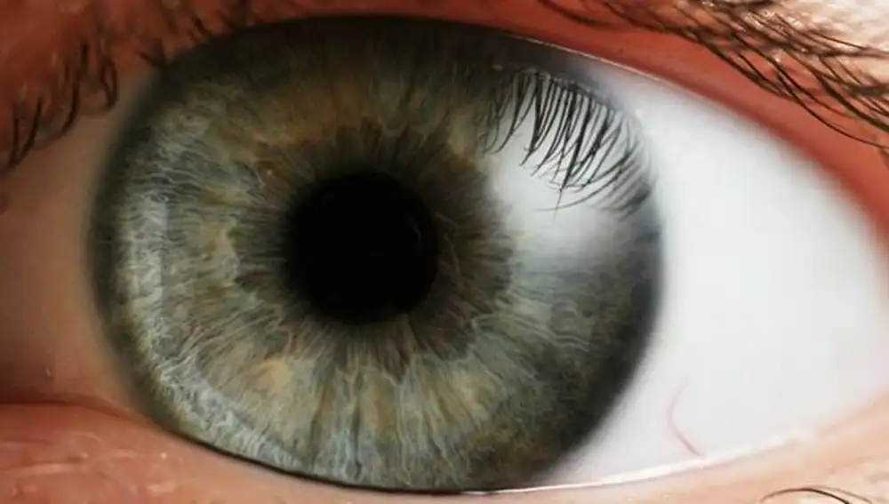 Ejemplo de desprendimiento de retina