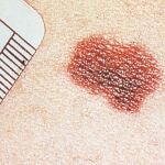 MÁS SUPERVIVENCIA PARA EL CÁNCER DE PIEL AVANZADO
