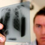 La pandemia de covid ha influido negativamente en el comportamiento epidémico de la tuberculosis, cuya incidencia lleva aumentando desde 2020