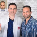 El Dr. Levent Acar y su equipo médico de la clínica Microfue de Estambul (Turquía), han revolucionado el paradigma mundial en la especialidad de trasplante capilar.
