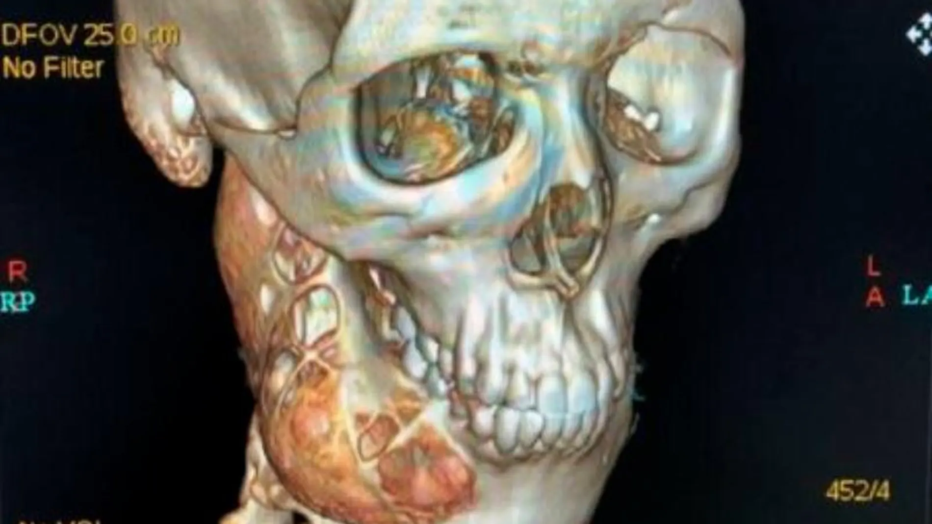 Tomografía 3D de la mandíbula del joven. Permite reconocer tridimensionalmente huesos y tejidos.