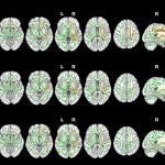 Imagen que muestra el efecto del insomnio en la sustancia blanca cerebral.
