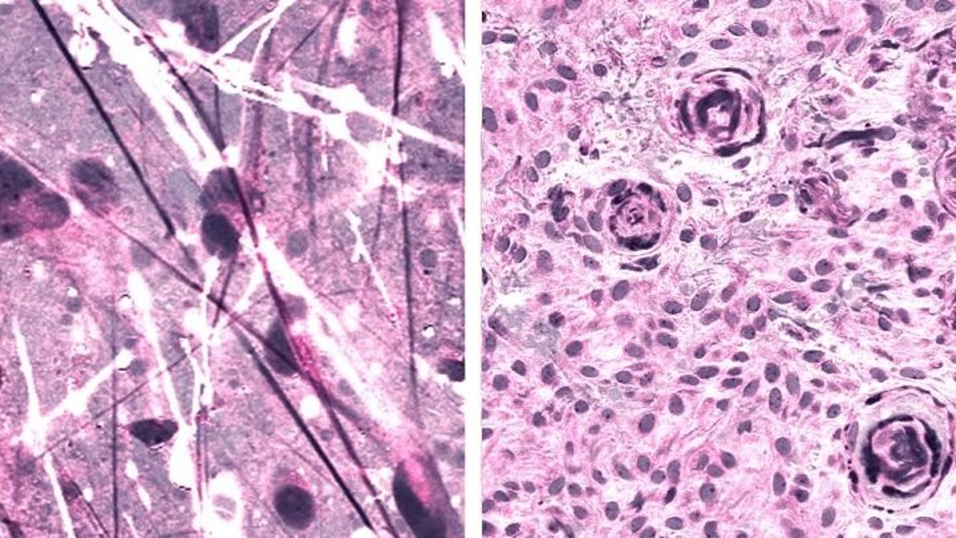 Un nuevo método que combina imágenes ópticas con inteligencia artificial detecta con precisión tumores cerebrales