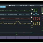 monitor trasplante corazon 2