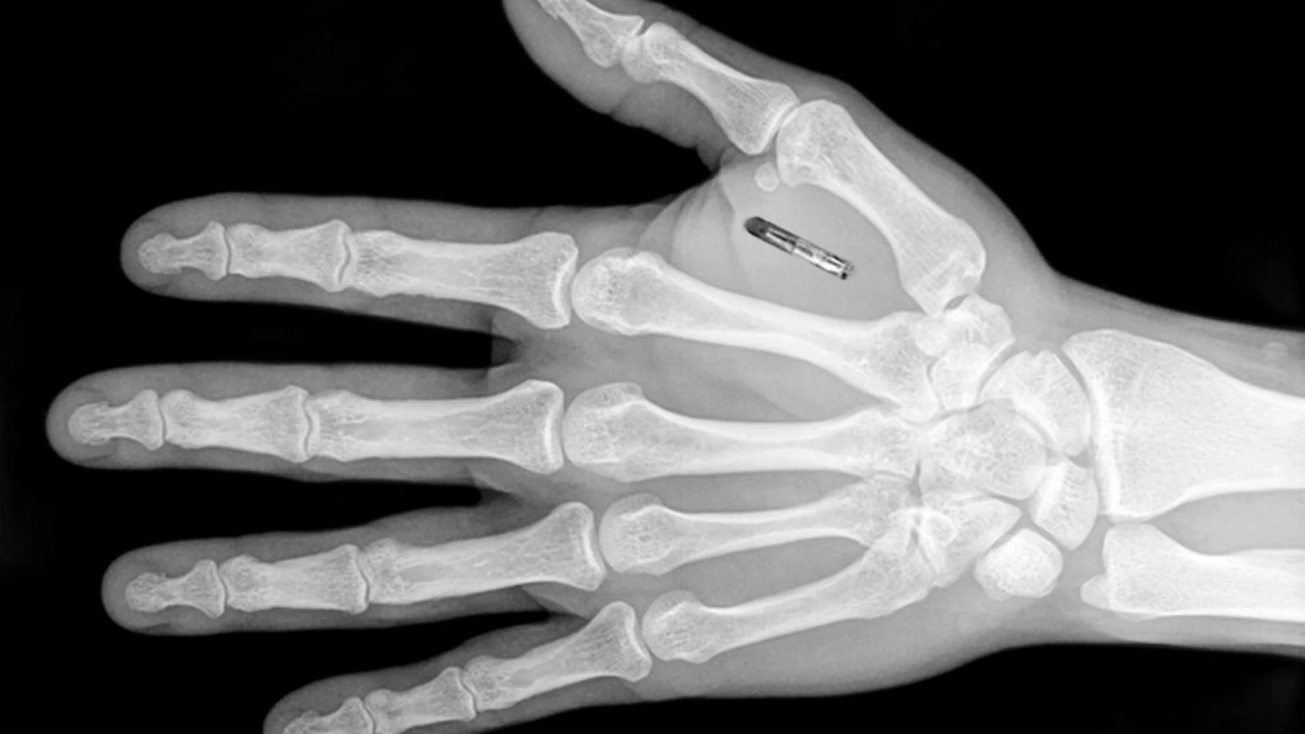 Así quedaría incorporado el microchip en la mano del trabajador