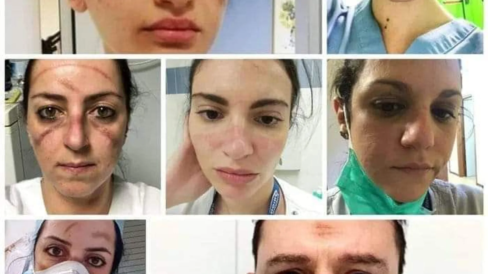 Imágenes de las marcas que las protecciones de seguridad que deberían llevar los sanitarios les dejan en el rostro.