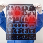 Radiografía con secuelas del coronavirus