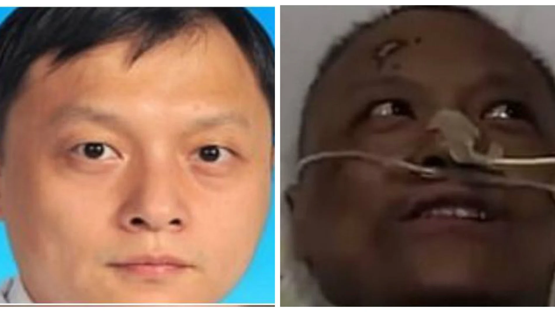 Al urólogo Hu Weifeng le cambió el color de la piel tras ser tratado con cloroquina para curar el Covid-19