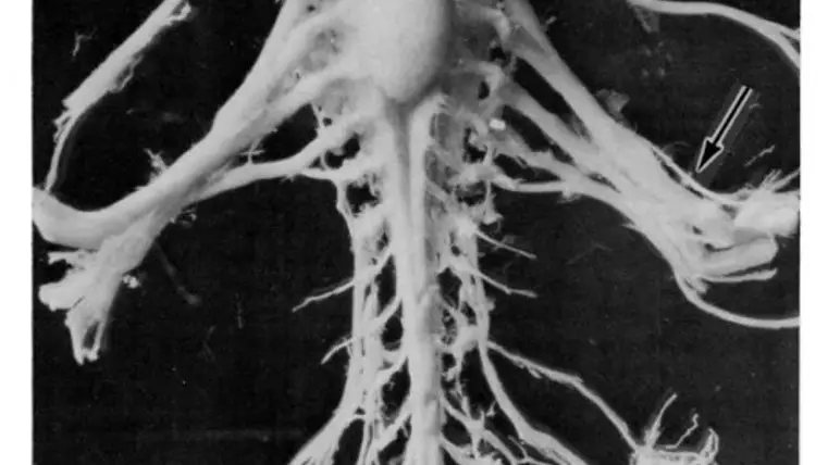 Cuerpo glicogénico diseccionado en 1949