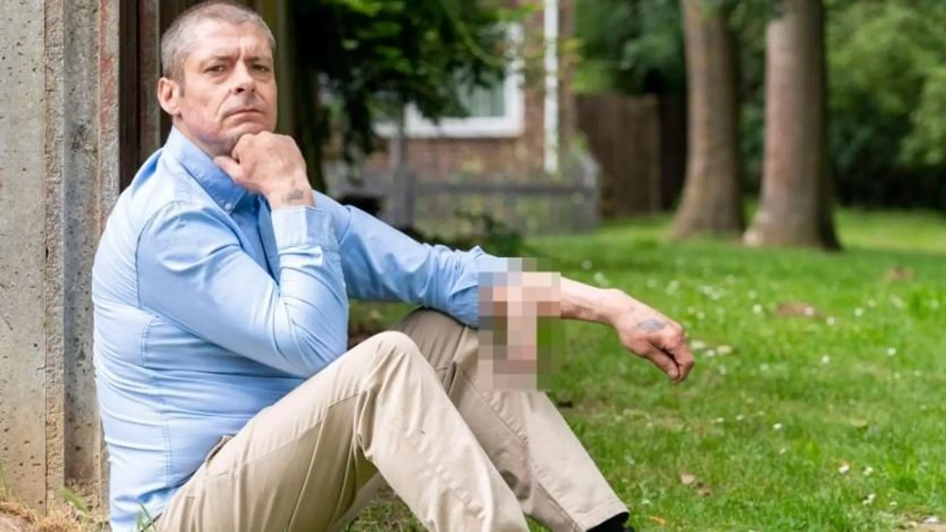 Malcolm lleva cuatro años con el pene colgando de su brazo y espera que pronto se lo implanten en su ubicación definitiva