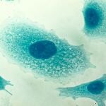 El cáncer de próstata es una enfermedad por la que se forman células malignas (cancerosas) en los tejidos de la próstata.
