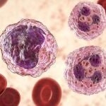 Cambios notables en el número y la proporción entre los diferentes tipos de células sanguíneas es un signo de leucemia