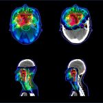 Distribución de la radiación en el cuerpo siendo representando el marrón la mayor intensidad y el azul oscuro la menor. A la izquierda se observa la distribución conseguida con radioterapia de intensidad modulada, a la derecha con protonterapia de intensidad modulada (un tipo de radioterapia.