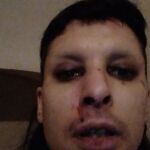 Nina colgó una imagen suya con las heridas en las redes sociales