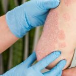PsoriasisAEDV19/01/2021