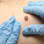 Un diagnóstico precoz de un melanoma puede suponer una enorme ventaja en el tratamiento | Fuente: Dreamstime
