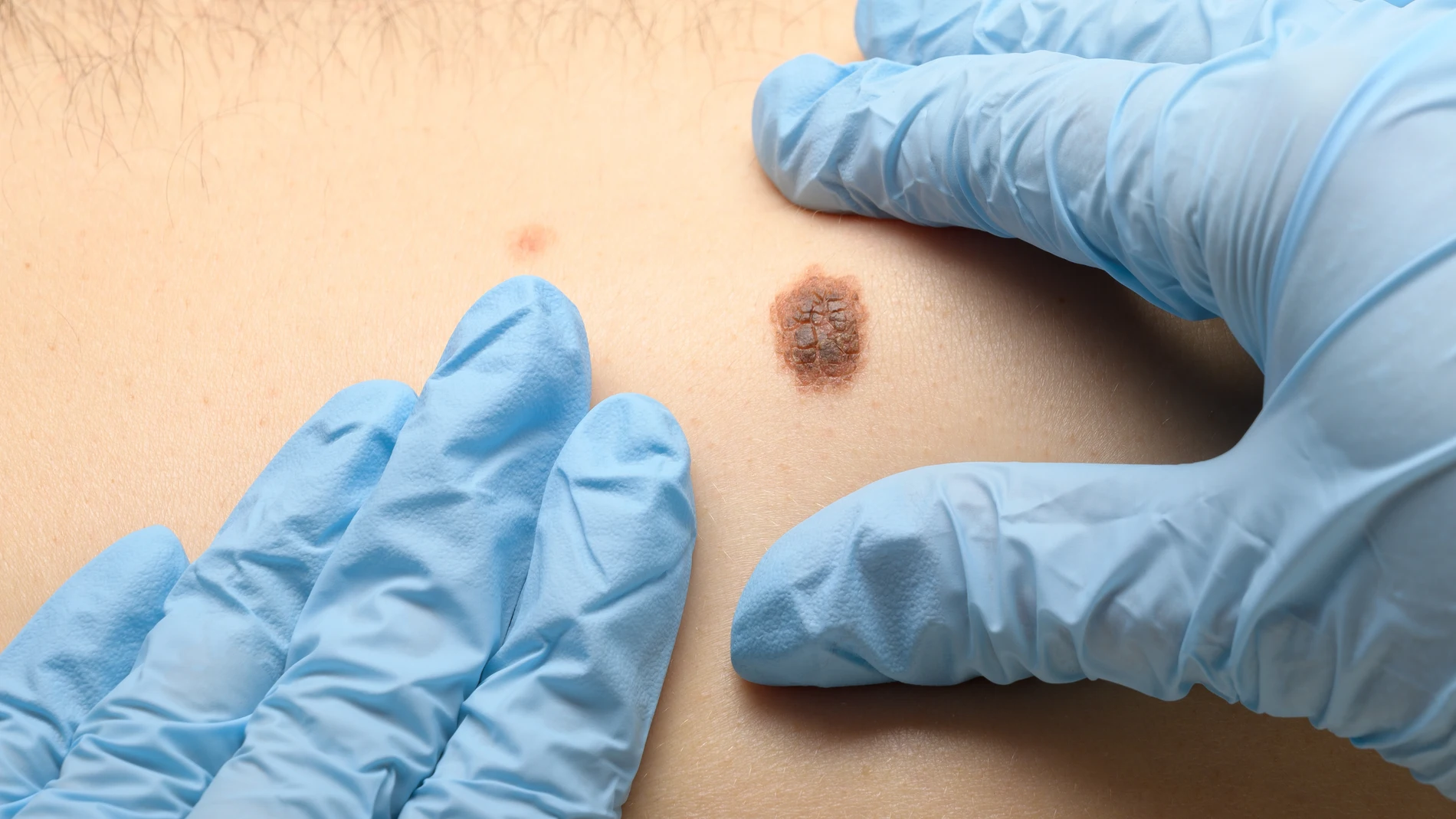 Un diagnóstico precoz de un melanoma puede suponer una enorme ventaja en el tratamiento | Fuente: Dreamstime