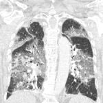 Escáner de los pulmones del paciente al que se le había ofrecido una inyección de AstraZeneca, pero la rechazó por miedo a desarrollar coagulación sanguínea. Ahora se encuentra luchando por su vida en un hospital neerlandés tras haberse contagiado de covid