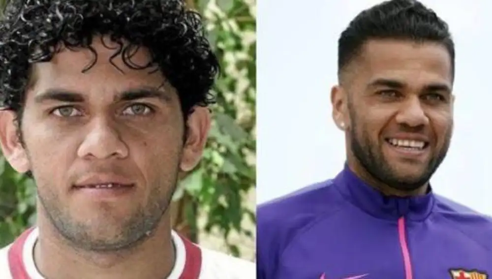 Alves se operó sus orejas de soplillo
