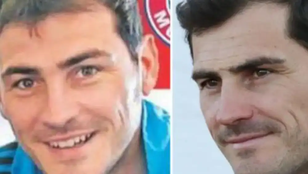 Casillas se ha sometido a dos injertos capilares