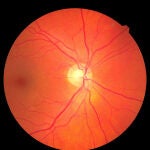 Unas 800.000 personas mayores de 65 años padecen degeneración macular asociada a la edad (DMAE) en España