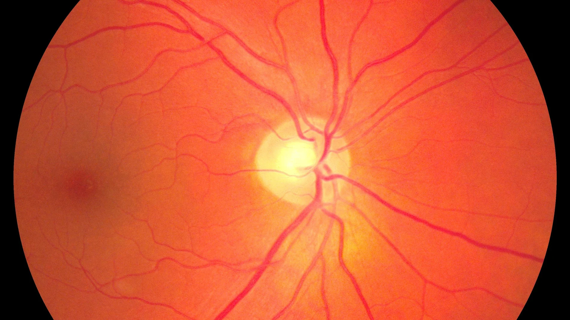 Unas 800.000 personas mayores de 65 años padecen degeneración macular asociada a la edad (DMAE) en España
