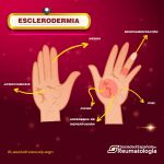 La esclerodermia afecta a 13.000 personas en nuestro país