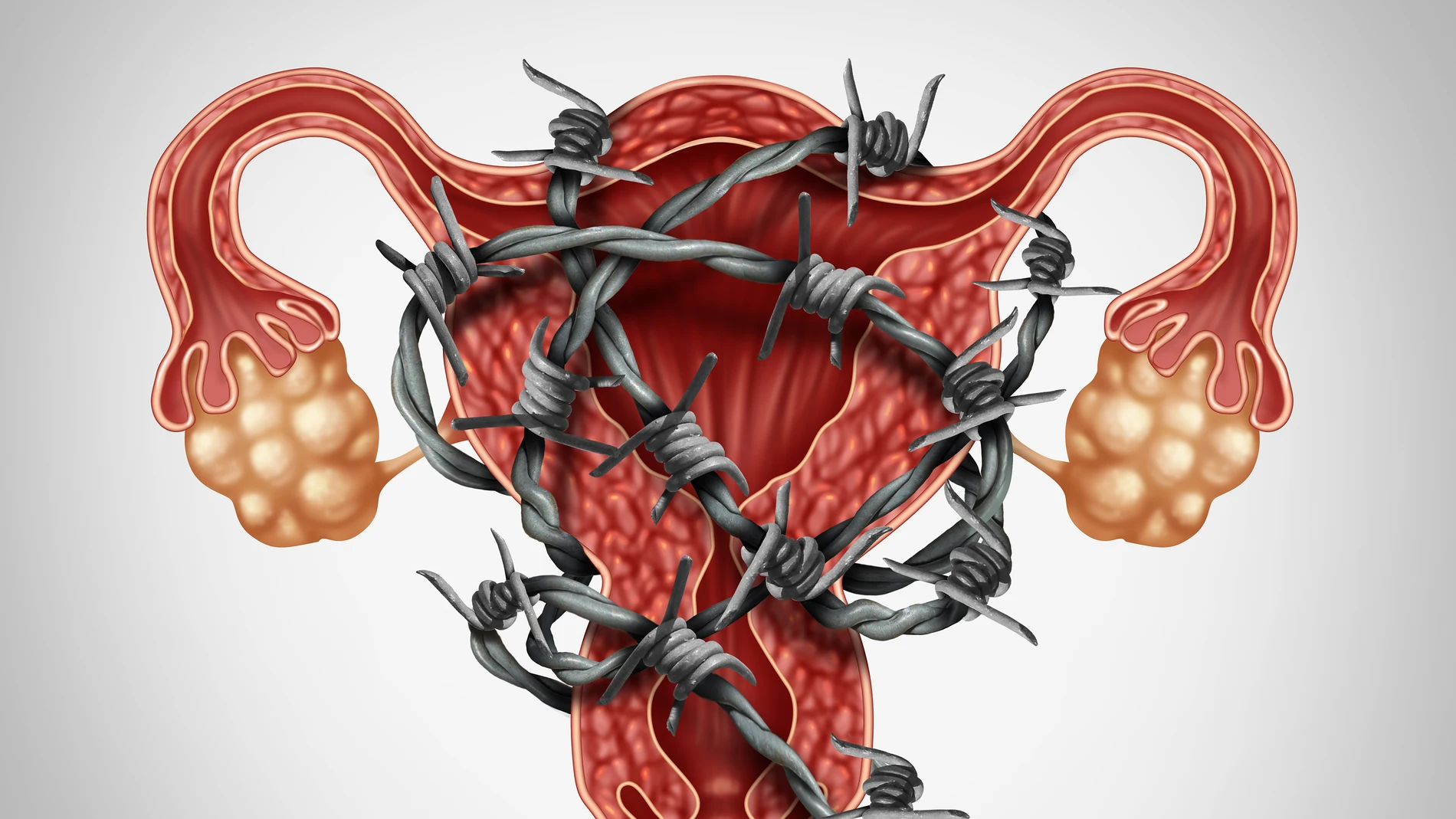 Endometriosis