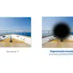 La DMAE es una enfermedad de la retina que afecta a la mácula, que es su porción más central y la parte más importante para la percepción de los detalles