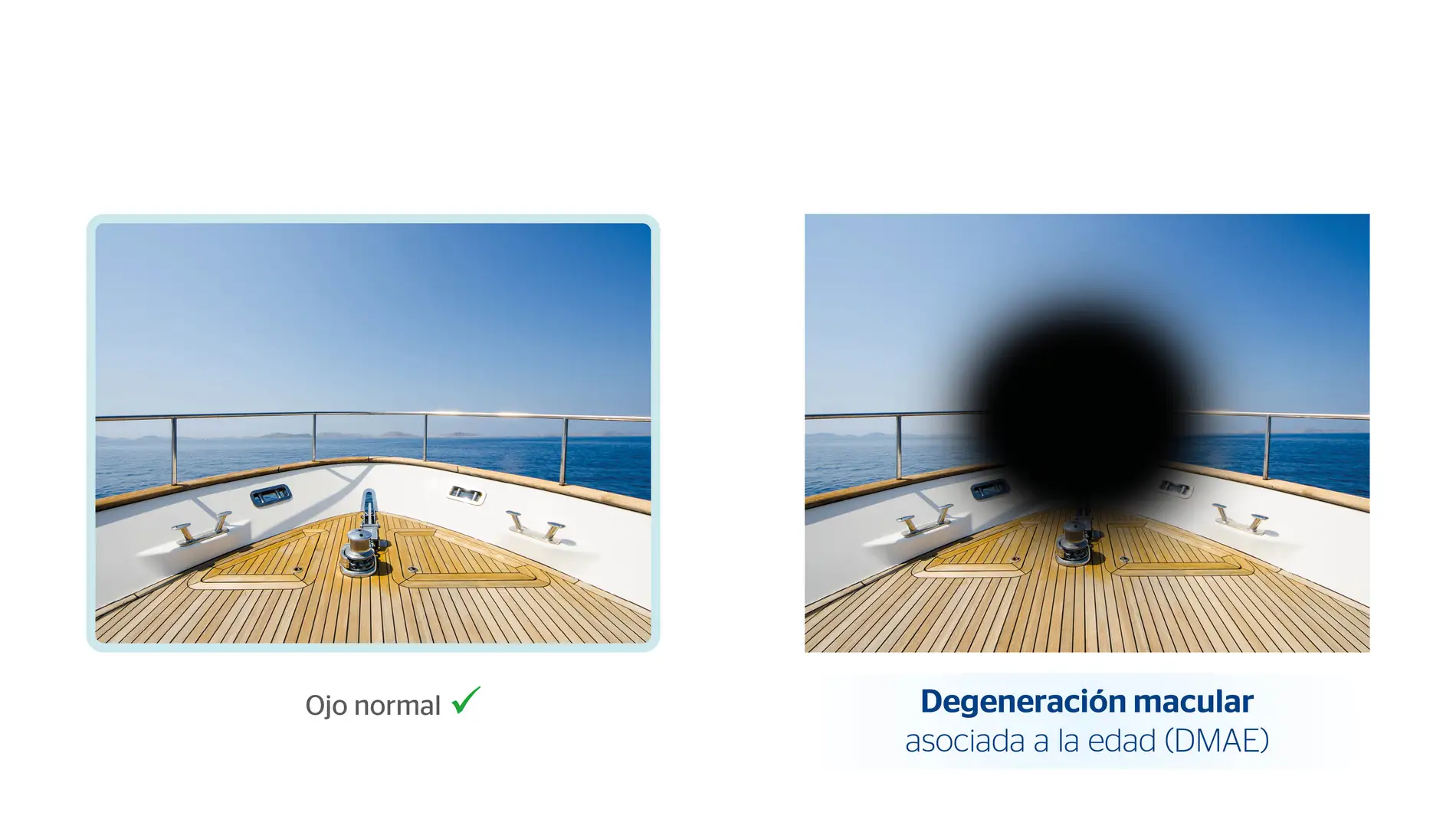 Degeneración macular asociada a la edad (DMAE)