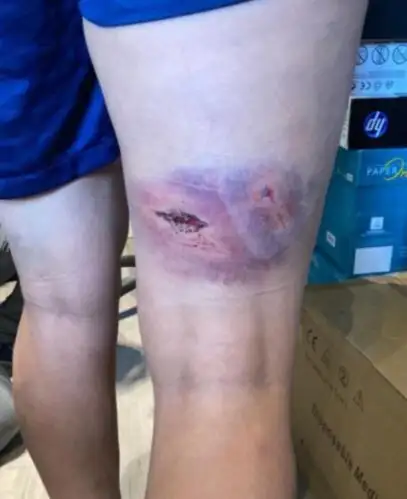 Así quedó la pierna de Kheira Hamraoui