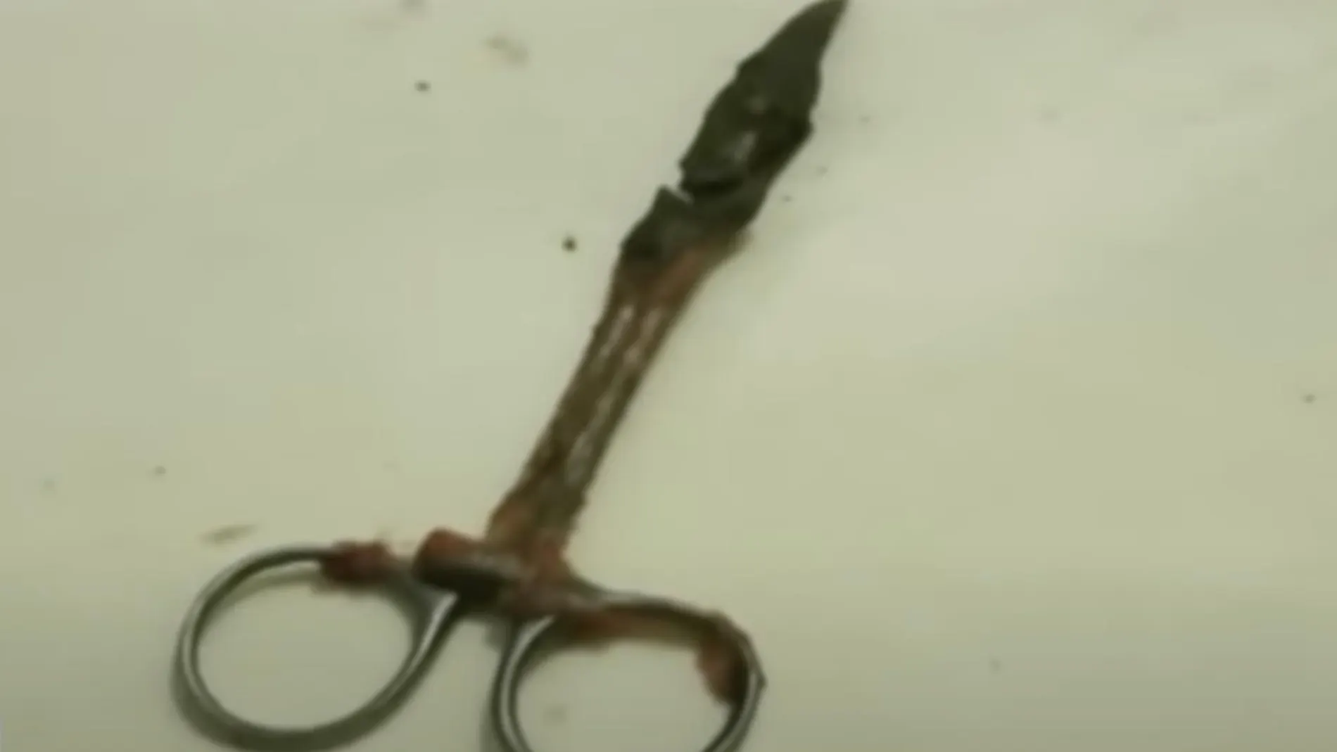 Tijera extraída a la mujer en Bangladesh