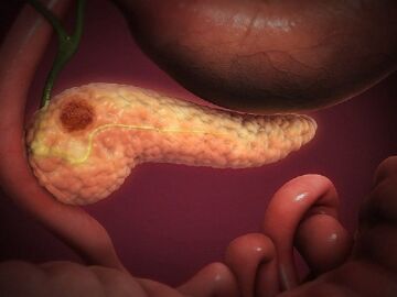 El c&aacute;ncer de p&aacute;ncreas tiene las tasas de supervivencia m&aacute;s bajas de los c&aacute;nceres comunes
