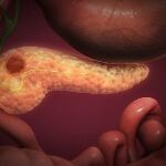 El cáncer de páncreas tiene las tasas de supervivencia más bajas de los cánceres comunes