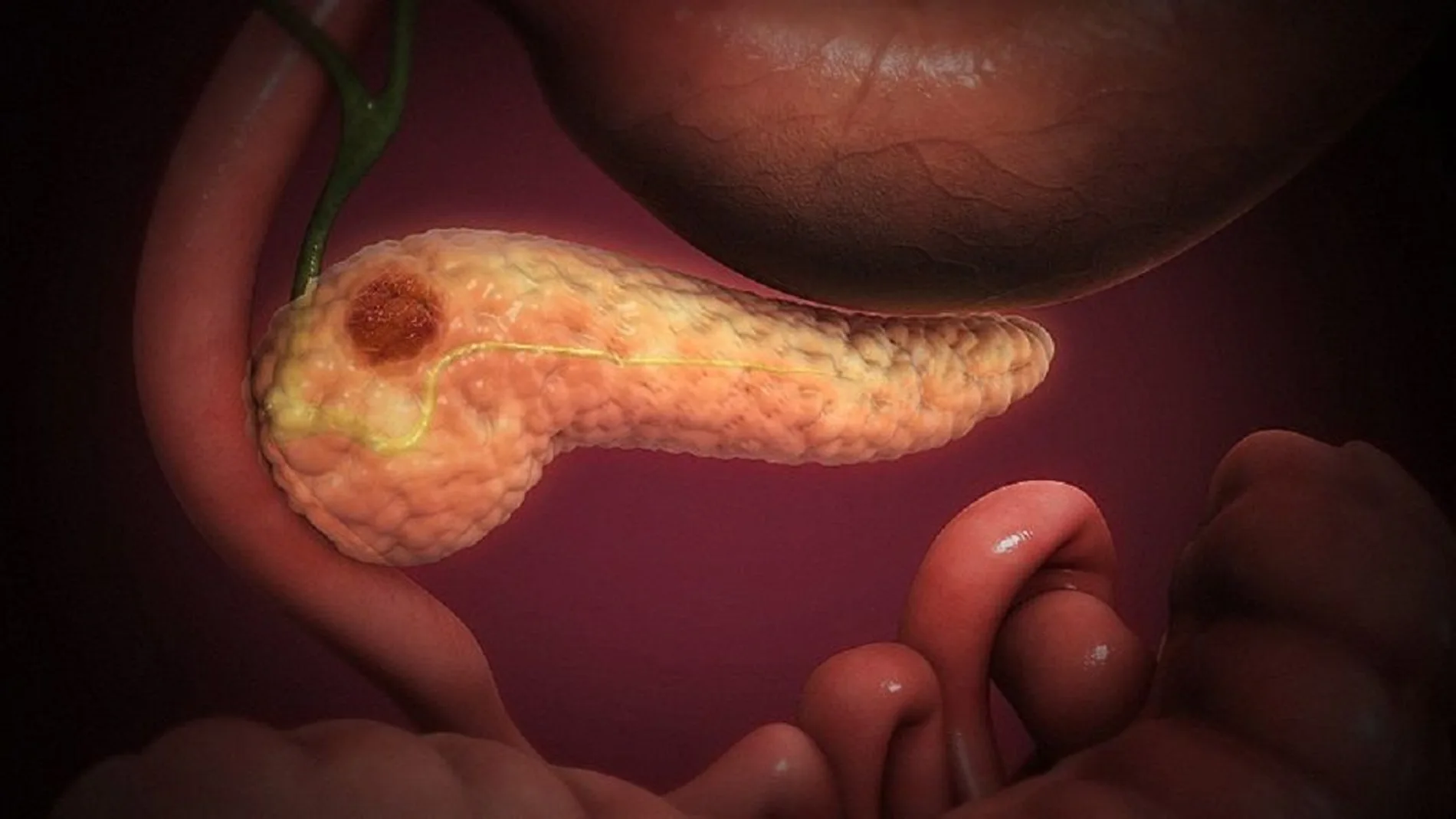 El cáncer de páncreas tiene las tasas de supervivencia más bajas de los cánceres comunes