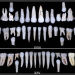 Dientes pertenecientes al individuo XVIII (arriba) y XXV (abajo) de la Sima de los Huesos