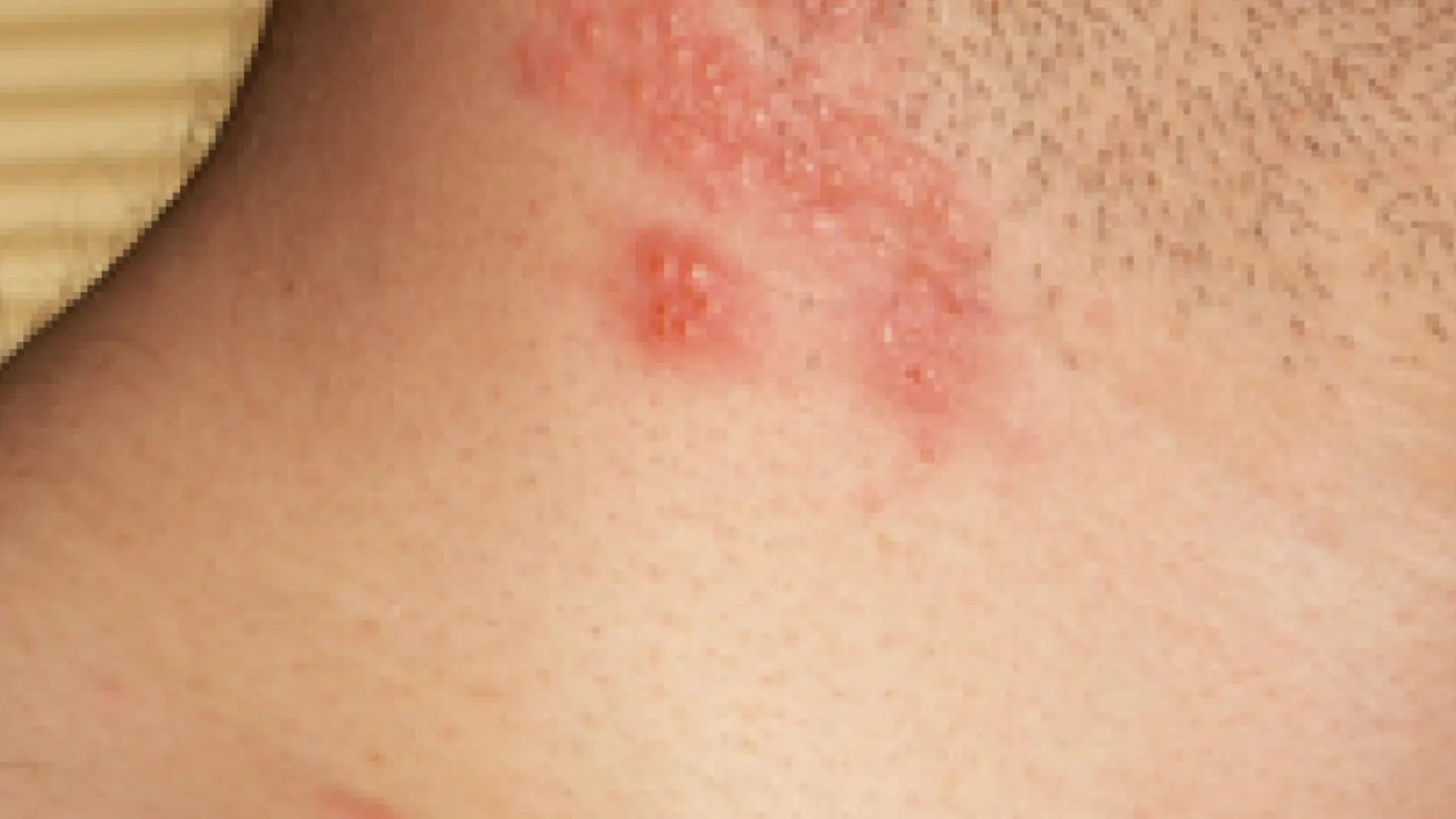 Aparición de ampollas debido a un herpes zoster