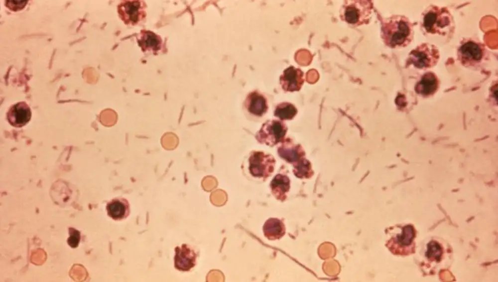 Microfotografía de heces en un paciente con shigelosis, que también se conoce como "disentería por Shigella" o "disentería bacteriana" | Dominio Público
