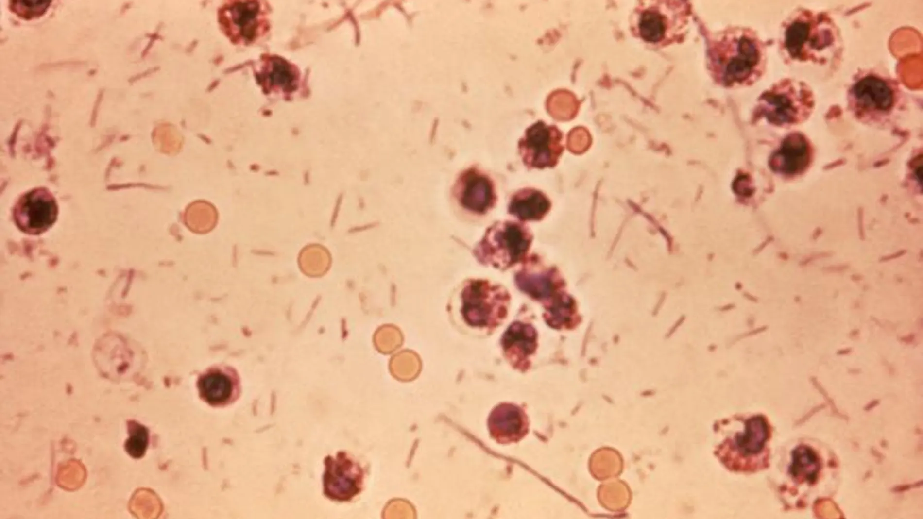 Microfotografía de heces en un paciente con shigelosis, que también se conoce como "disentería por Shigella" o "disentería bacteriana" | Dominio Público