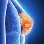 El triple negativo es uno de los carcinomas más agresivos y difíciles de tratar