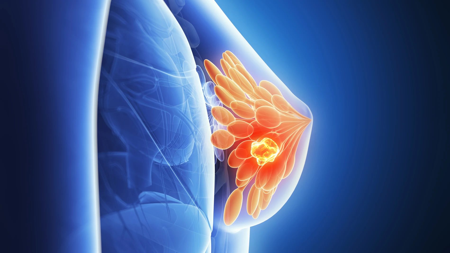 El triple negativo es uno de los carcinomas más agresivos y difíciles de tratar