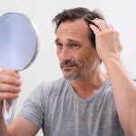 Alopecia