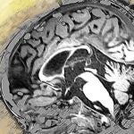 Cerebro con leucodistrofia