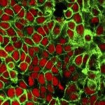Imagen microscópica de células cancerígenas en el colon